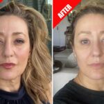 The hot new trend? A non-surgical facelift with no downtime