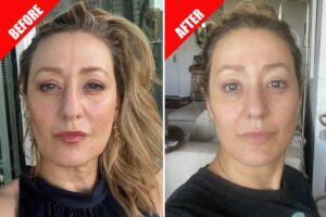 The hot new trend? A non-surgical facelift with no downtime

